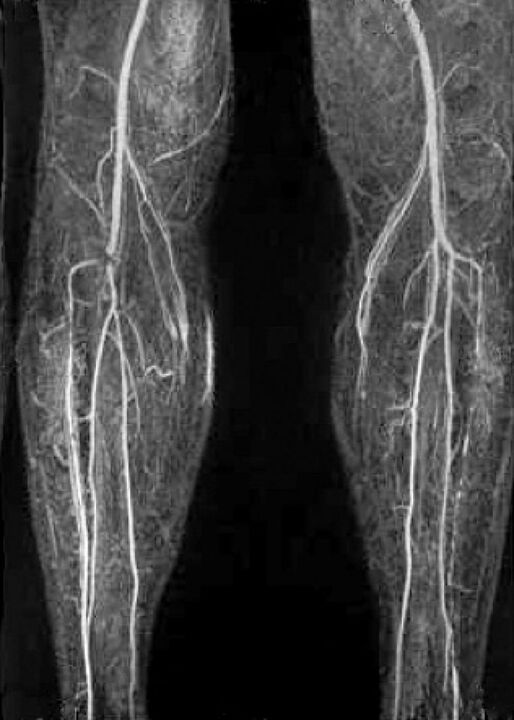 Vasküler X -Ray