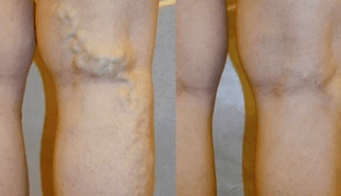 Erkeklerde bacaklarda varis belirtileri ve semptomları