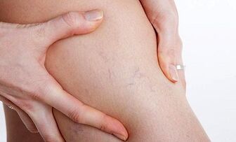 bacaklarda varisli damarların gelişmesinin nedenleri