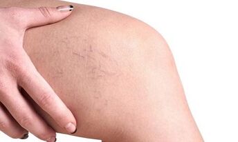 varisli damarların gelişim aşamaları