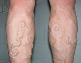 Bacaklarda 3. derece varisli damarlar