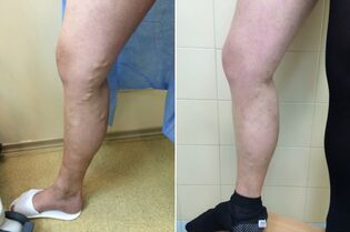 fotoğraflardan önce ve sonra varisli damarların lazer tedavisi