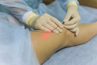 varisli damarların lazer tedavisi prosedürün özü