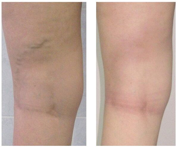 varis tedavisi öncesi ve sonrası bacaktaki damar