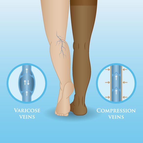 Basılı giysilerin bacaklardaki varisler üzerindeki etkileri