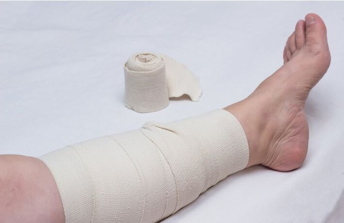 varisli damarlar için bacakta sıkıştırma bandajı