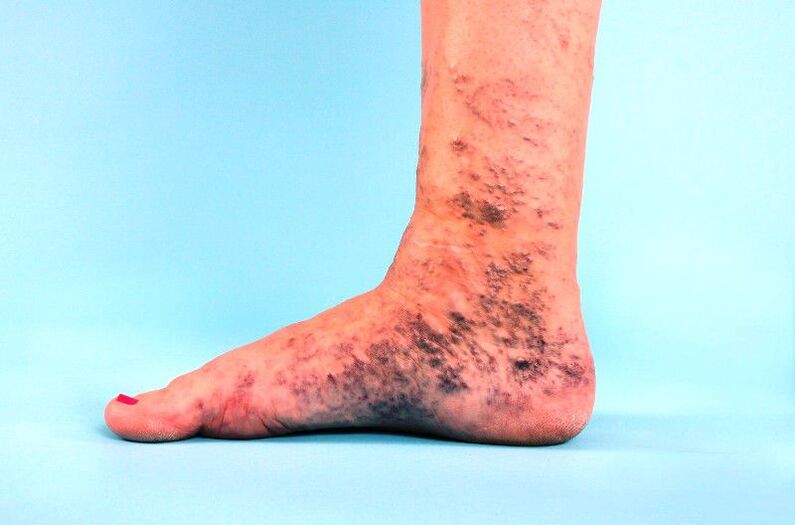 bacakta ihmal edilen varisli damarlar
