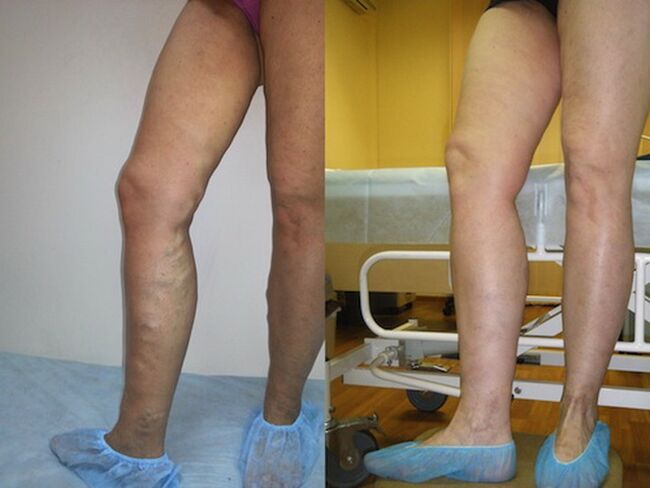 Varisli damarların lazer tedavisi öncesi ve sonrası bacaklar