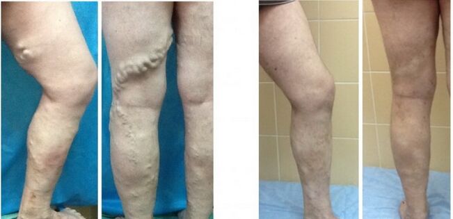 Varisli damarların radyofrekans obliterasyonundan önce ve sonra bacaklar