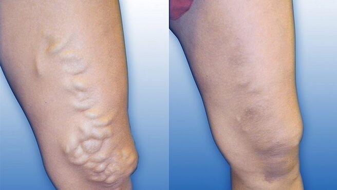 Şiddetli varis tedavisi öncesi ve sonrası bacaklar