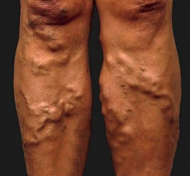 bacaklarda ihmal edilen varisli damarlar