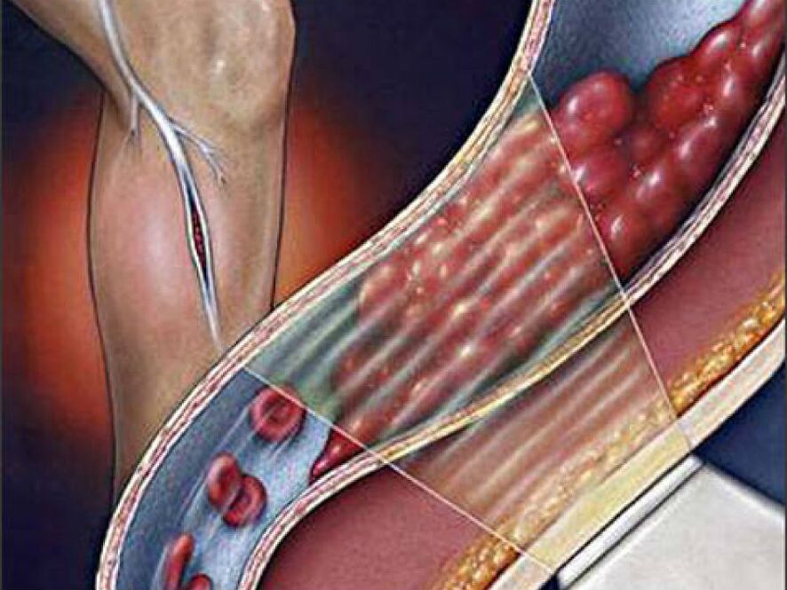 varisli damarların bir komplikasyonu olarak derin ven trombozu