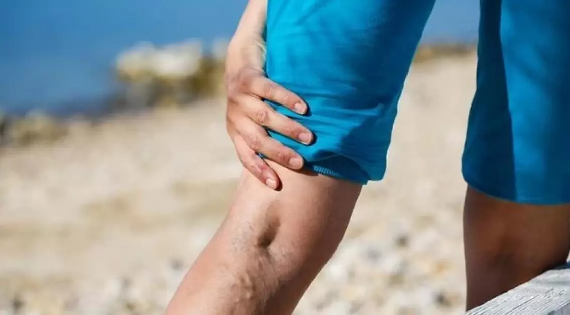 Bacaklardaki şişkin mavi damarlar varisli damarların bir işaretidir. 